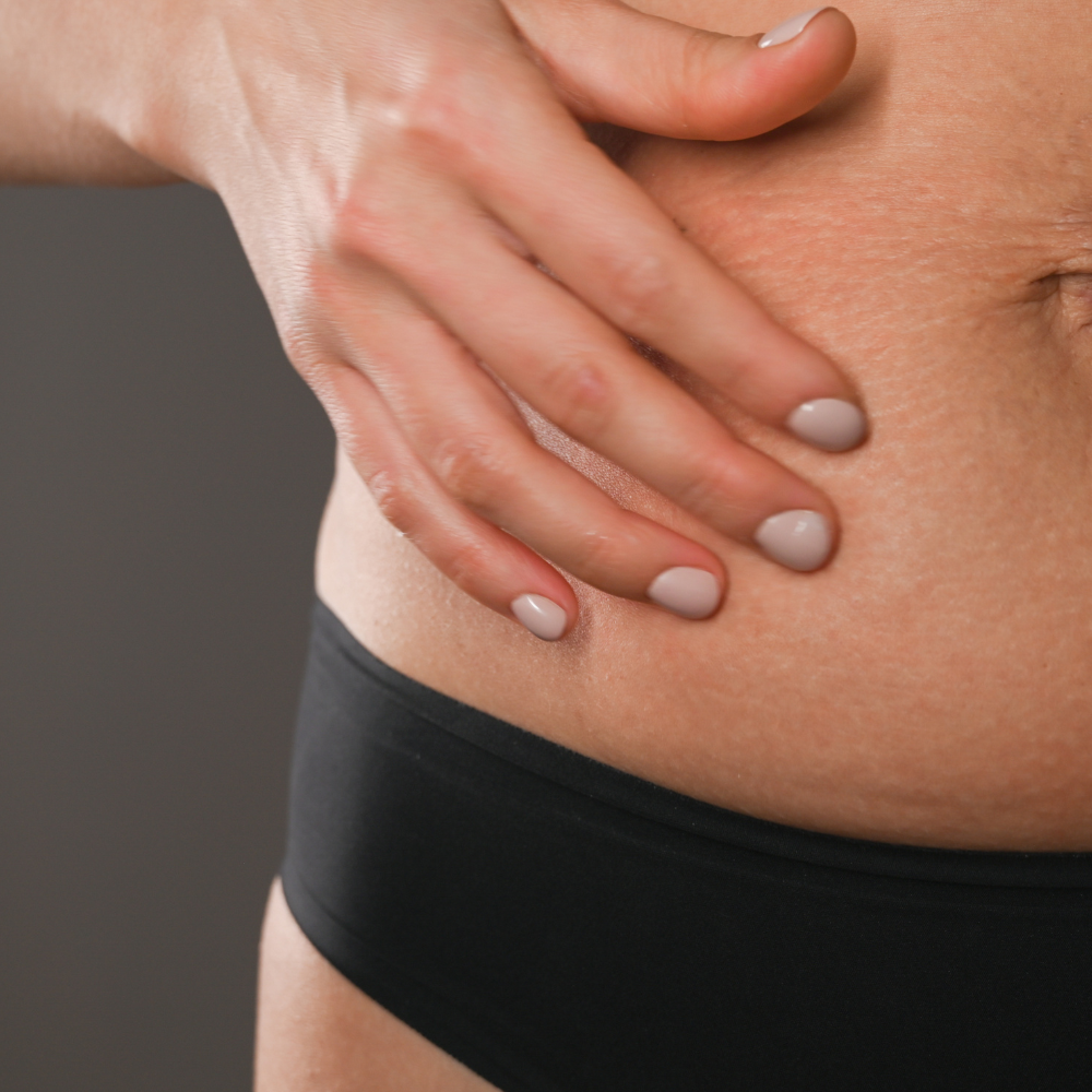 What is Advanced Stretch Marks Rejuvenation